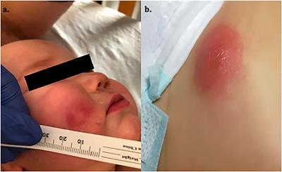 X-Linked Agammaglobulinemia Presenting as Neutropenia: Case Report and an Overview of Literature